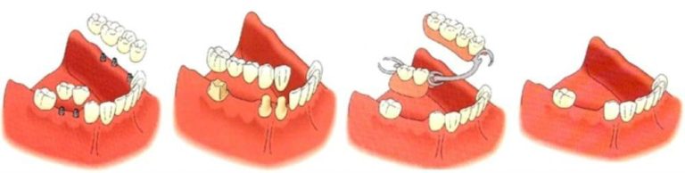 Tipos de puentes dentales fijos
